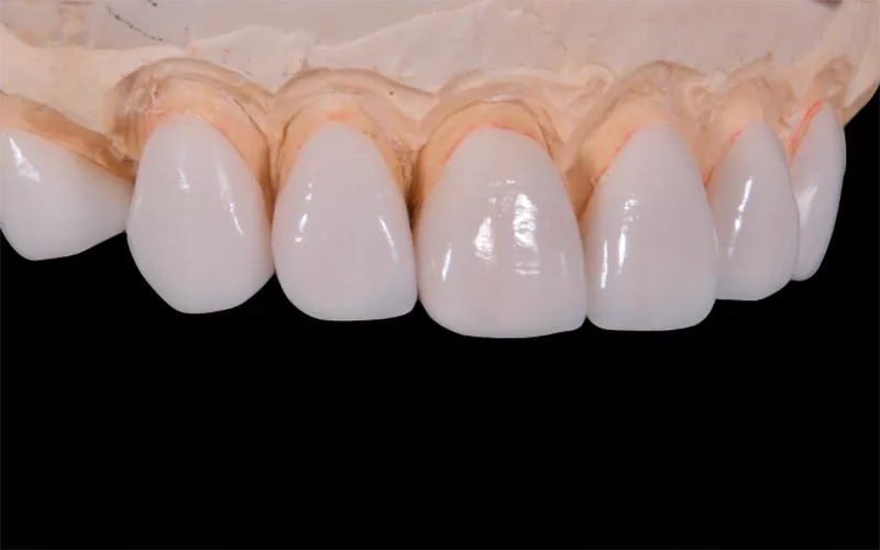 17 rodzajów cyrkonii wyjaśnione