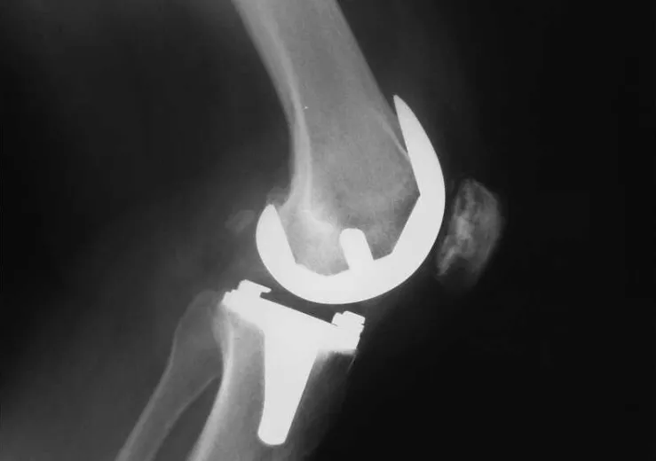 Magnezyum Oksit Stabilize Zirkonyum Seramikler Hakkında Her Şey ve Neden Yeni Bir Favori Olduğu
